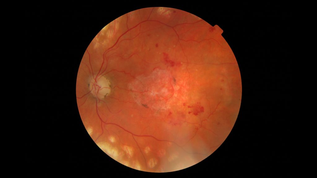 diabetic retinopathy