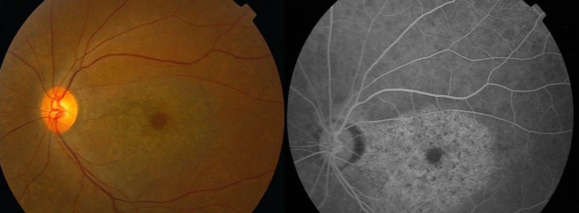 Eye Screening For Hydroxychloroquine